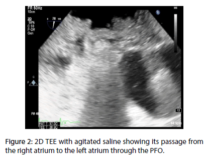 interventional-cardiology-left-atrium