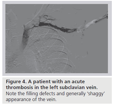 interventional-cardiology-left-filling