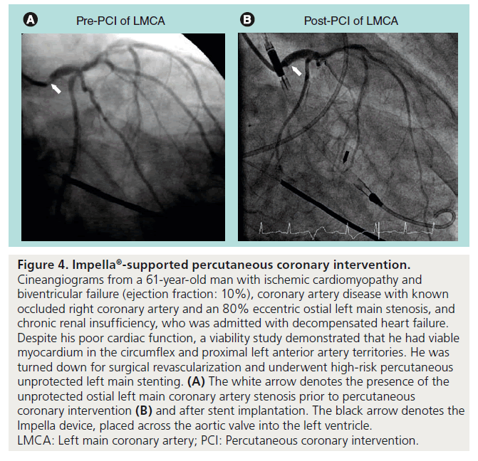 interventional-cardiology-left-ventricle