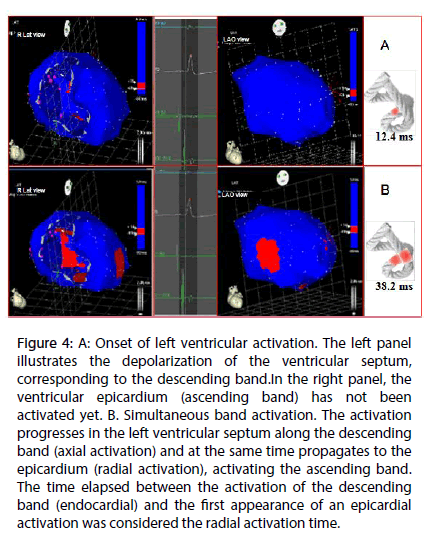 interventional-cardiology-left-ventricular