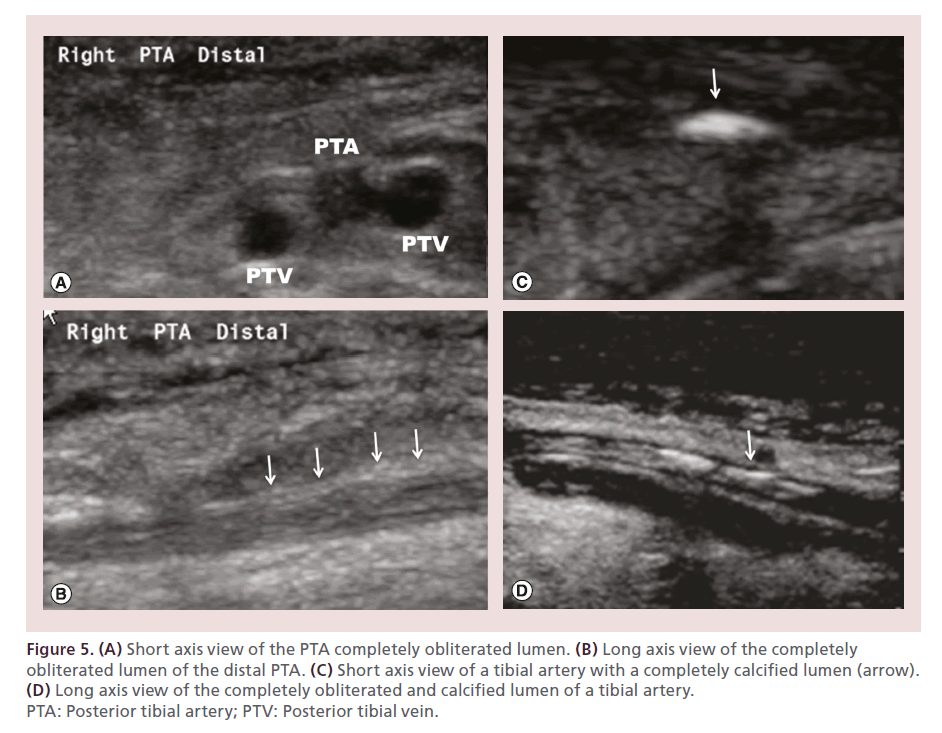 interventional-cardiology-lumen-tibial-artery