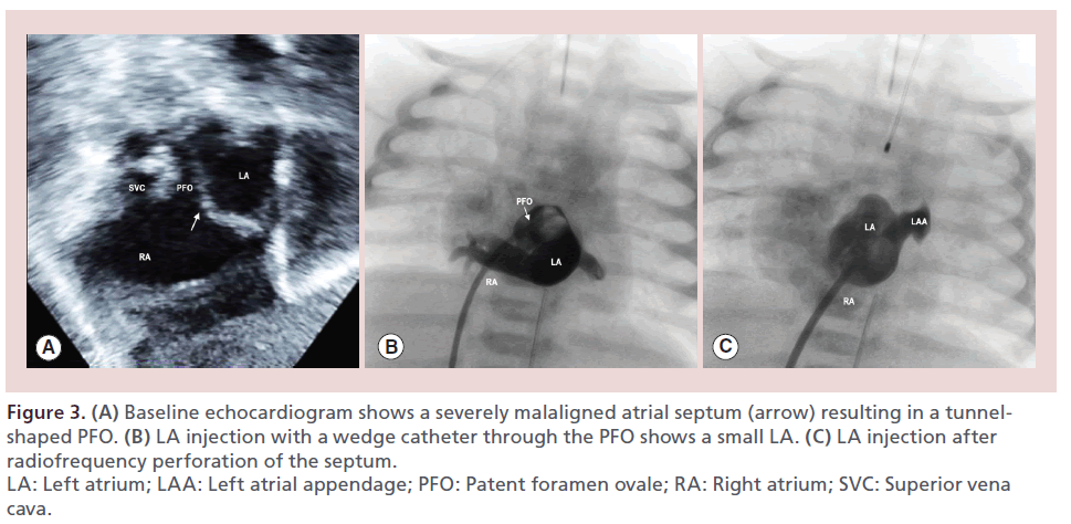 interventional-cardiology-malaligned-atrial-septum