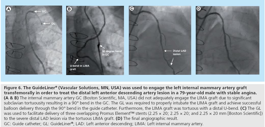 interventional-cardiology-male-stable-angina