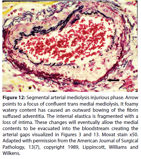 interventional-cardiology-medial-mediolysis