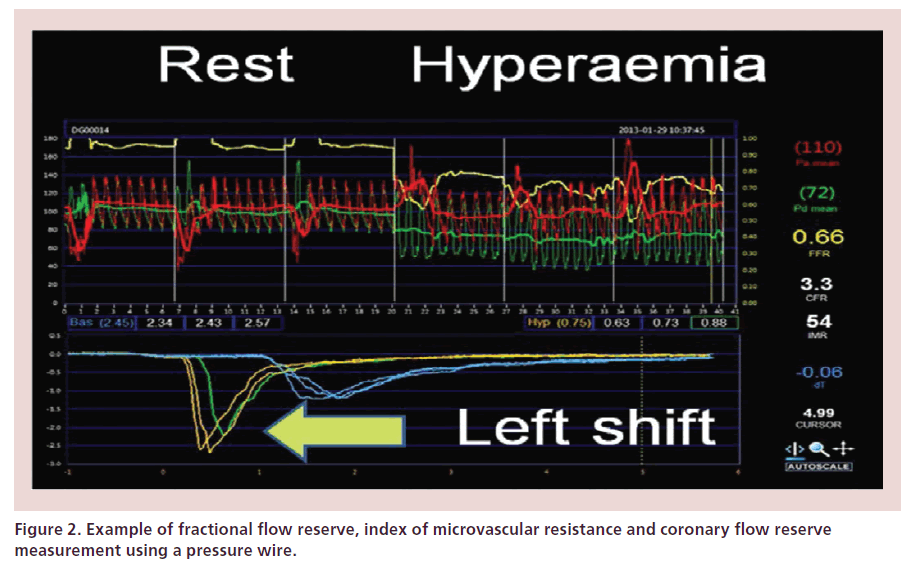 interventional-cardiology-microvascular-resistance