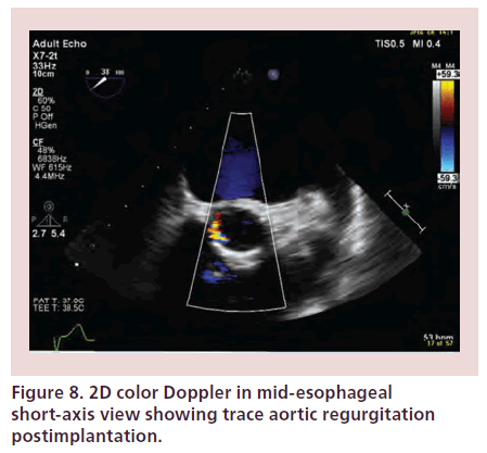 interventional-cardiology-mid-esophageal