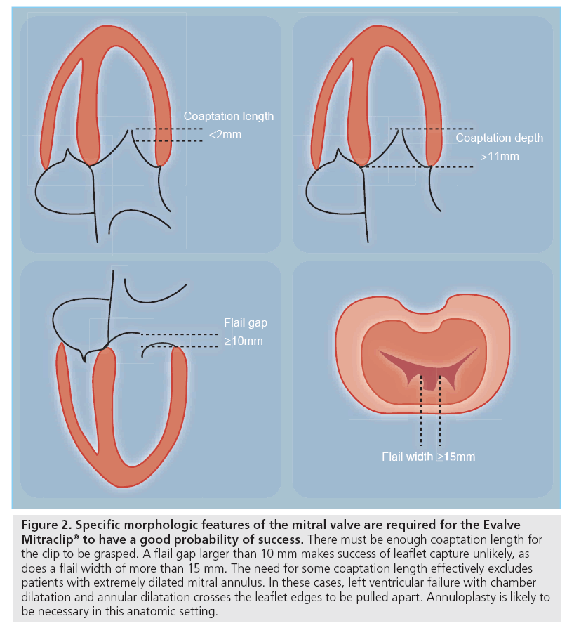 interventional-cardiology-mitral-valve