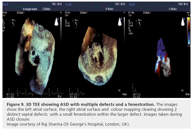 interventional-cardiology-multiple-defects