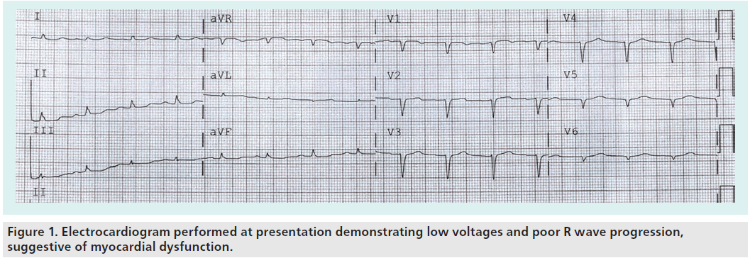 interventional-cardiology-myocardial