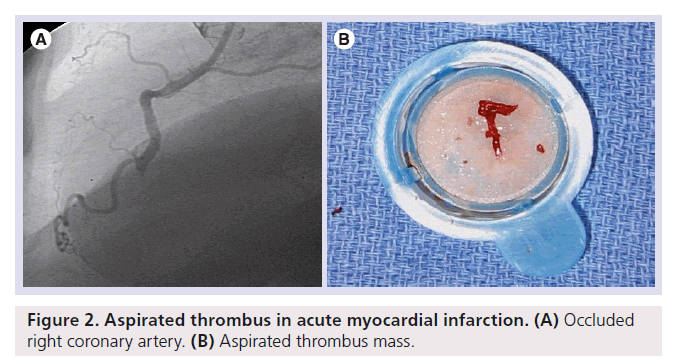 interventional-cardiology-myocardial-infarction