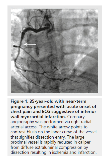 interventional-cardiology-myocardial-infarction