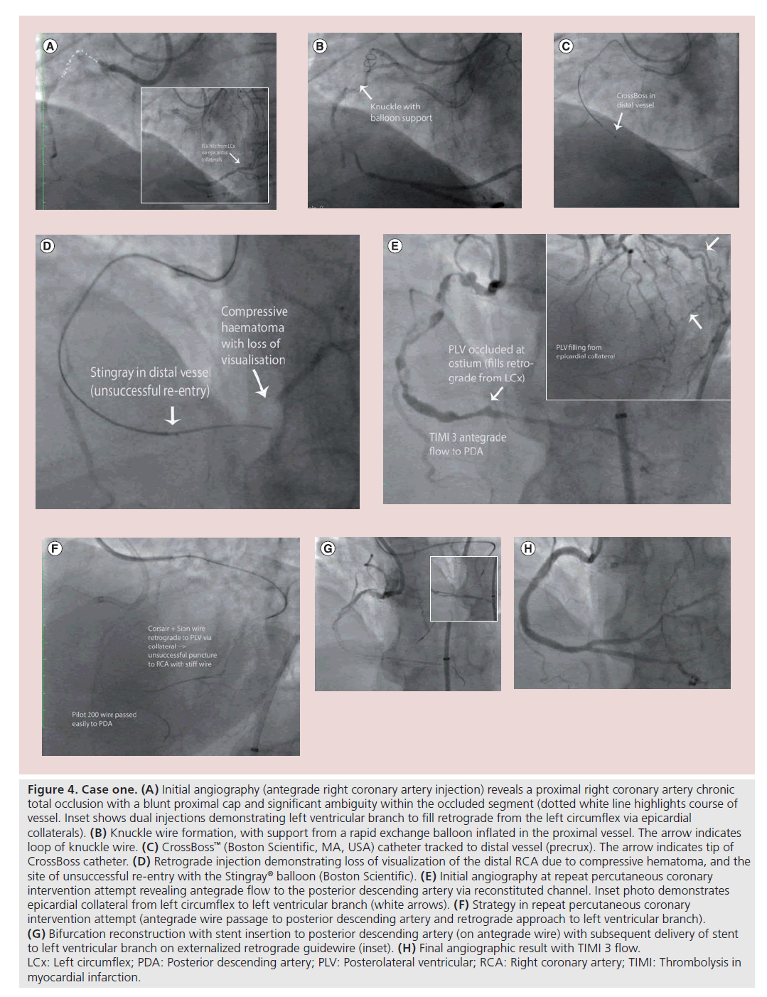 interventional-cardiology-myocardial-infarction