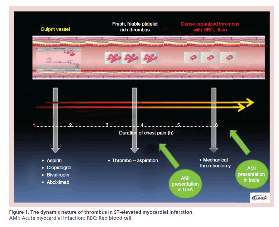 interventional-cardiology-myocardial-infarction