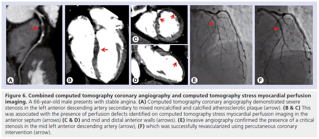 interventional-cardiology-myocardial-perfusion