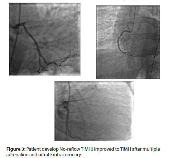 interventional-cardiology-nitrate