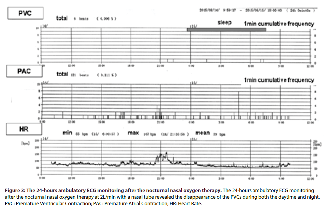 interventional-cardiology-nocturnal-nasal-oxygen-therapy