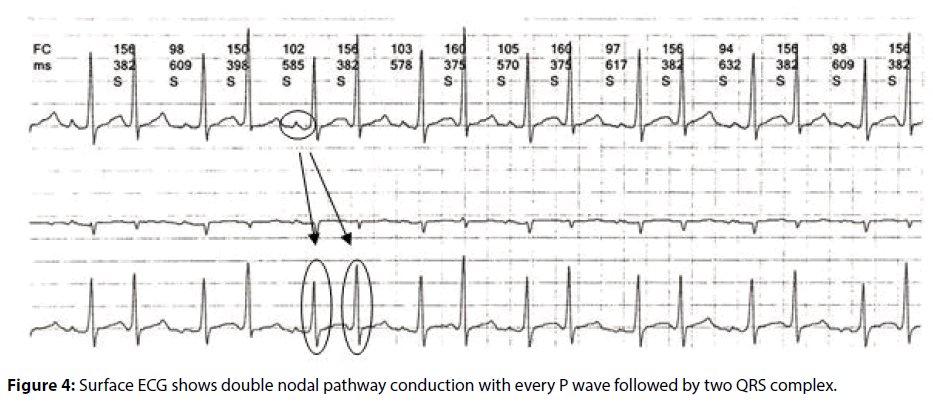 interventional-cardiology-nodal-pathway