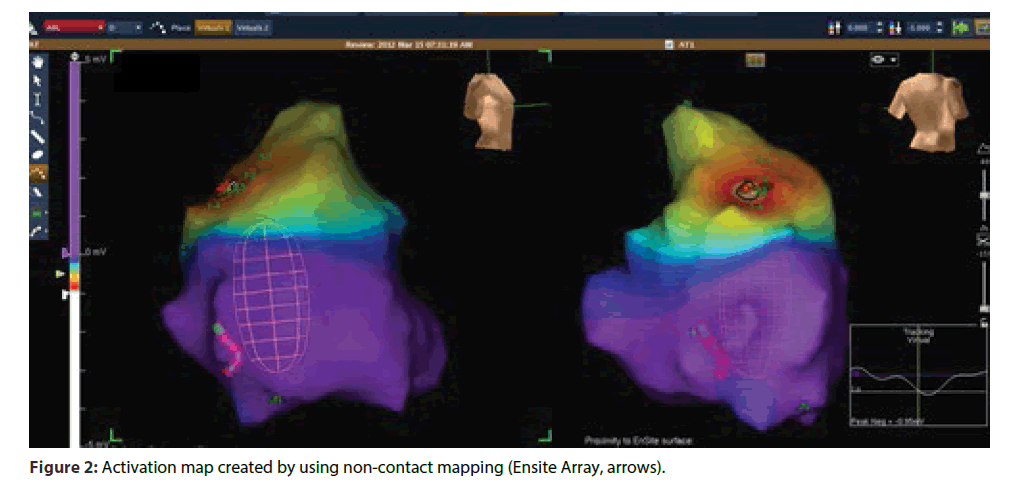 interventional-cardiology-non-contact-mapping