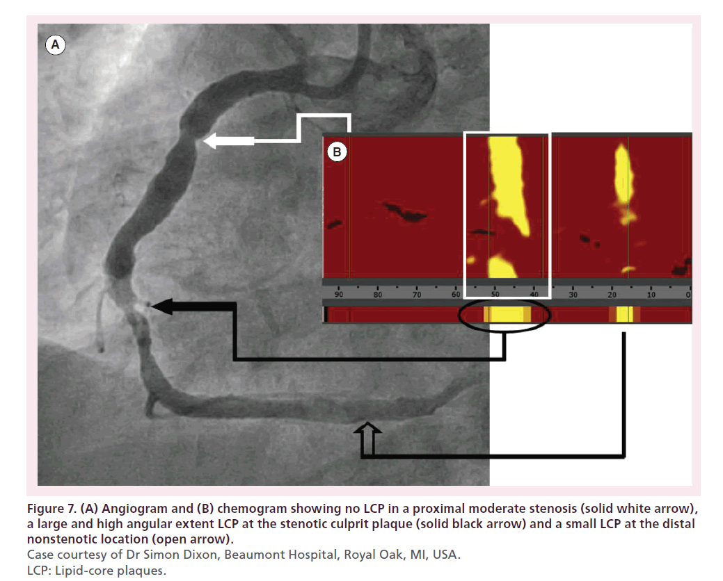 interventional-cardiology-nonstenotic-location