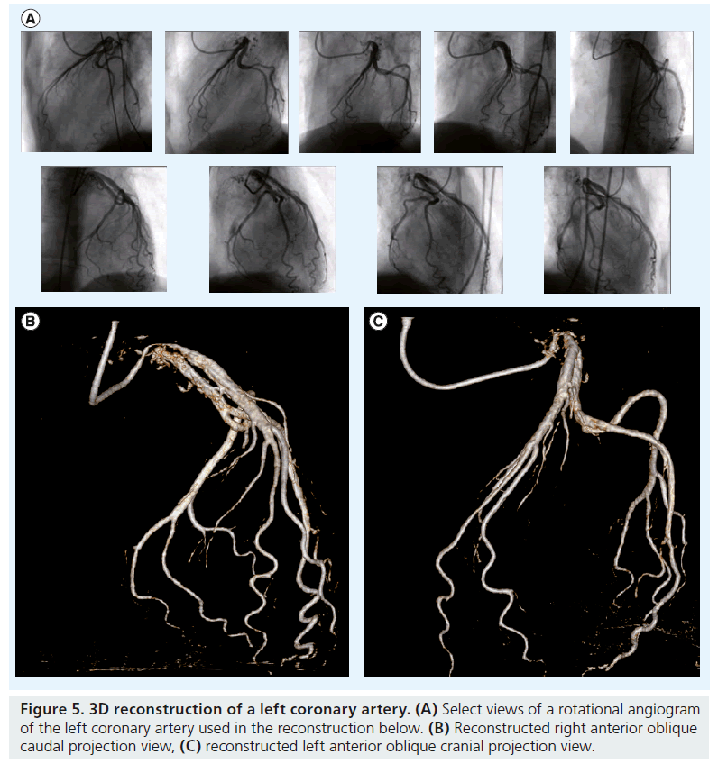 interventional-cardiology-oblique-cranial