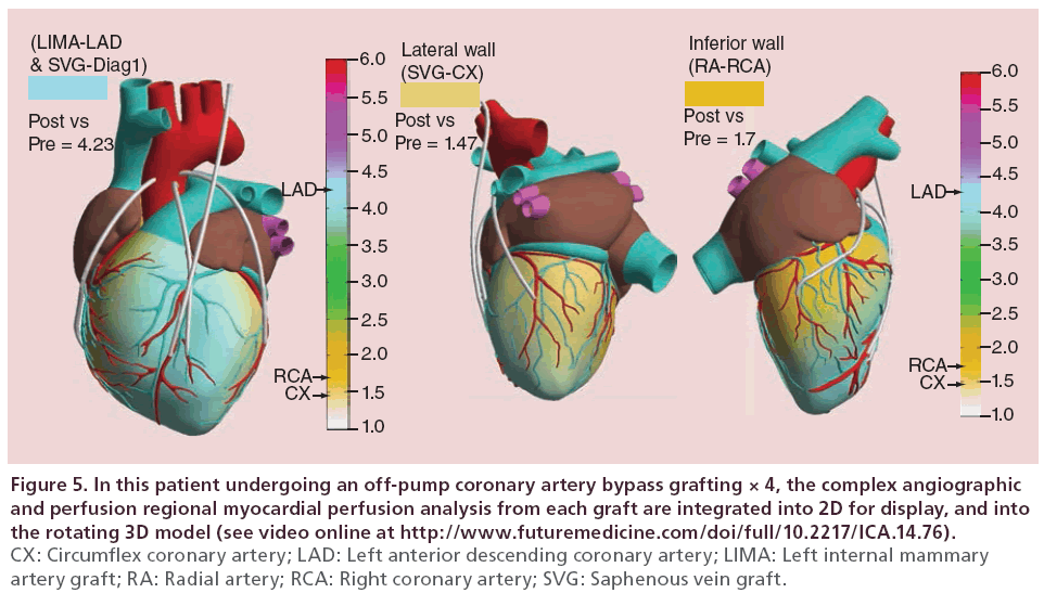 interventional-cardiology-off-pump-coronary-artery