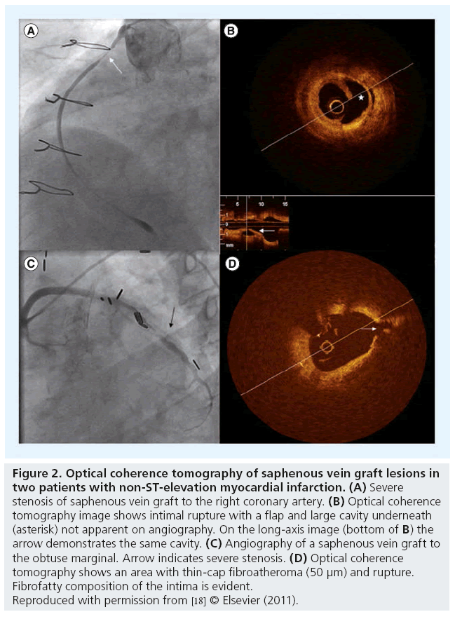 interventional-cardiology-optical-coherence