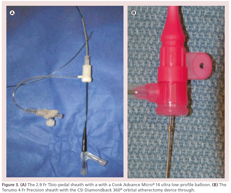 interventional-cardiology-orbital-atherectomy-device