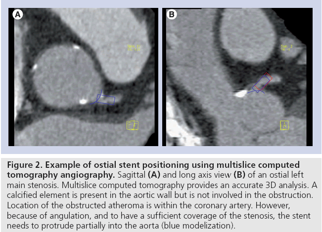 interventional-cardiology-ostial-stent-positioning