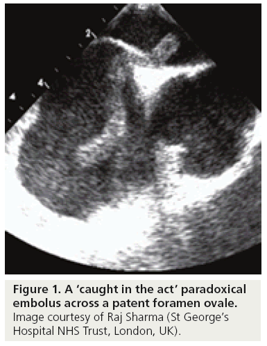 interventional-cardiology-paradoxical-embolus