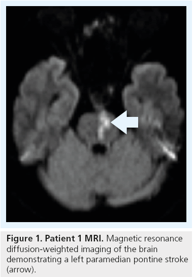 interventional-cardiology-paramedian-pontine-stroke