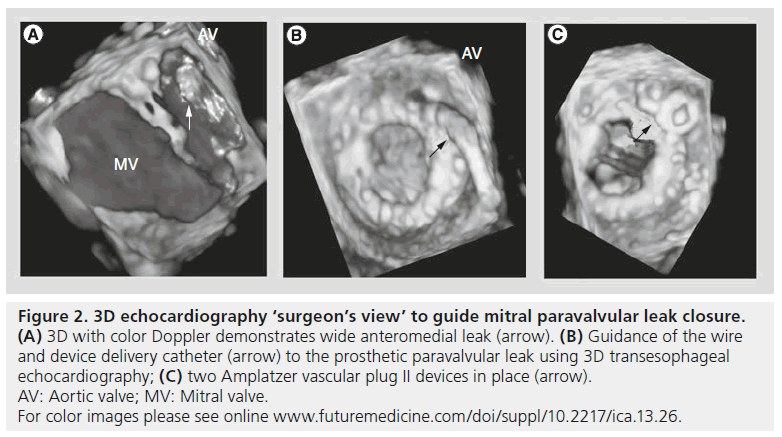 interventional-cardiology-paravalvular-leak