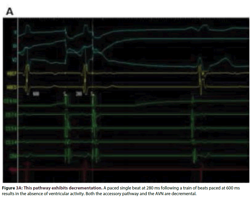 interventional-cardiology-pathway-exhibits