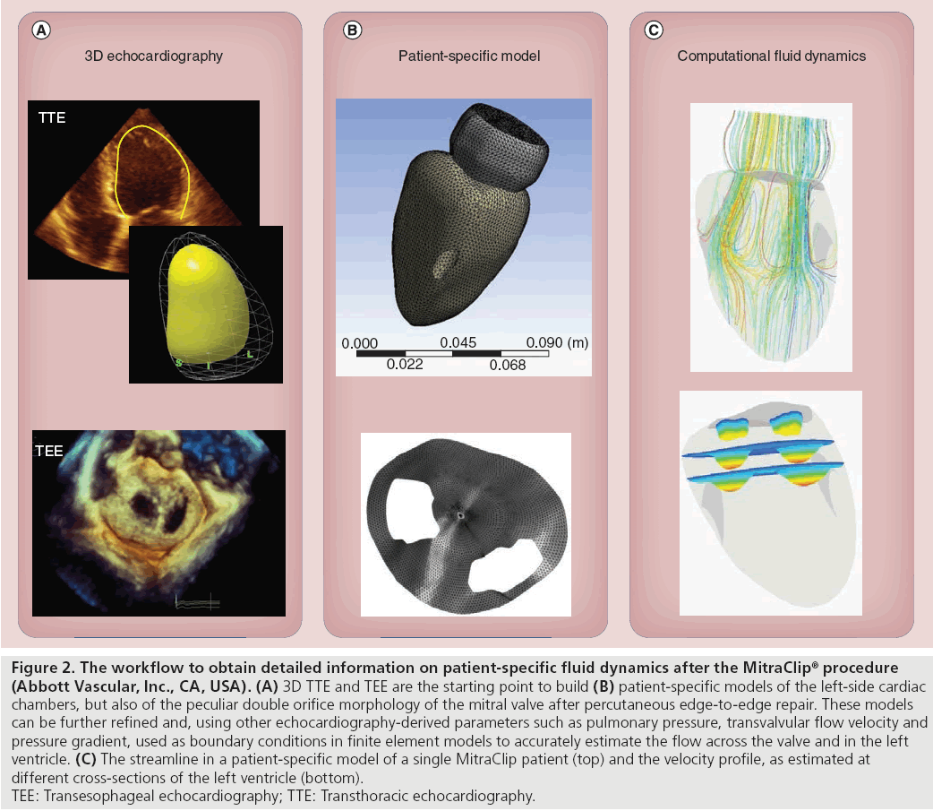 interventional-cardiology-patient-specific-fluid