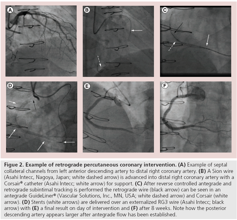 interventional-cardiology-percutaneous-coronary-intervention