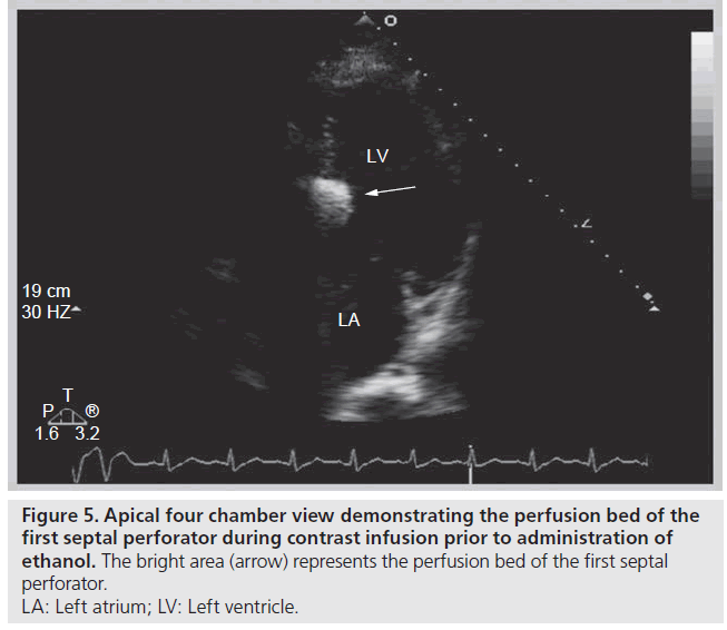 interventional-cardiology-perfusion