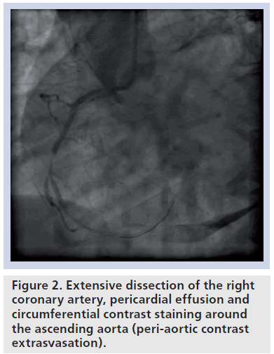 interventional-cardiology-pericardial