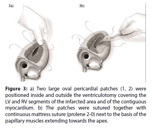 interventional-cardiology-pericardial-patches