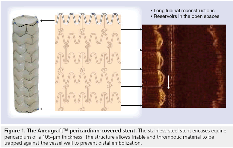 interventional-cardiology-pericardium-covered-stent