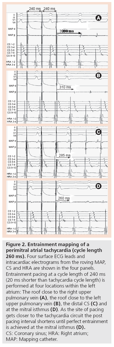 interventional-cardiology-perimitral-atrial