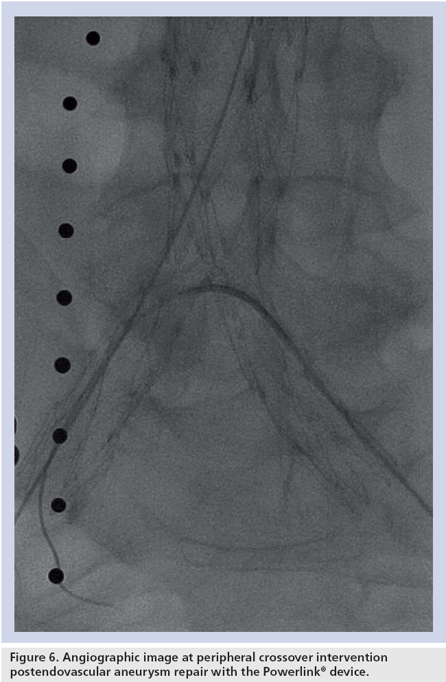 interventional-cardiology-peripheral-crossover-intervention