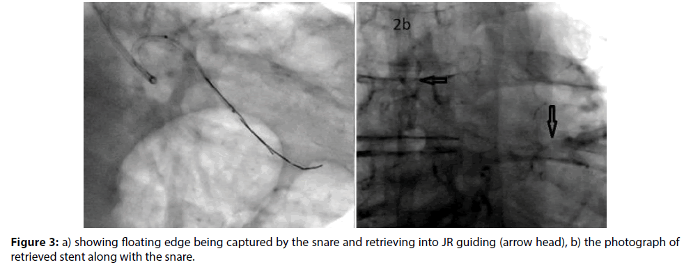 interventional-cardiology-photograph-snare