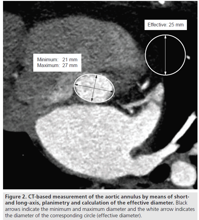 interventional-cardiology-planimetry