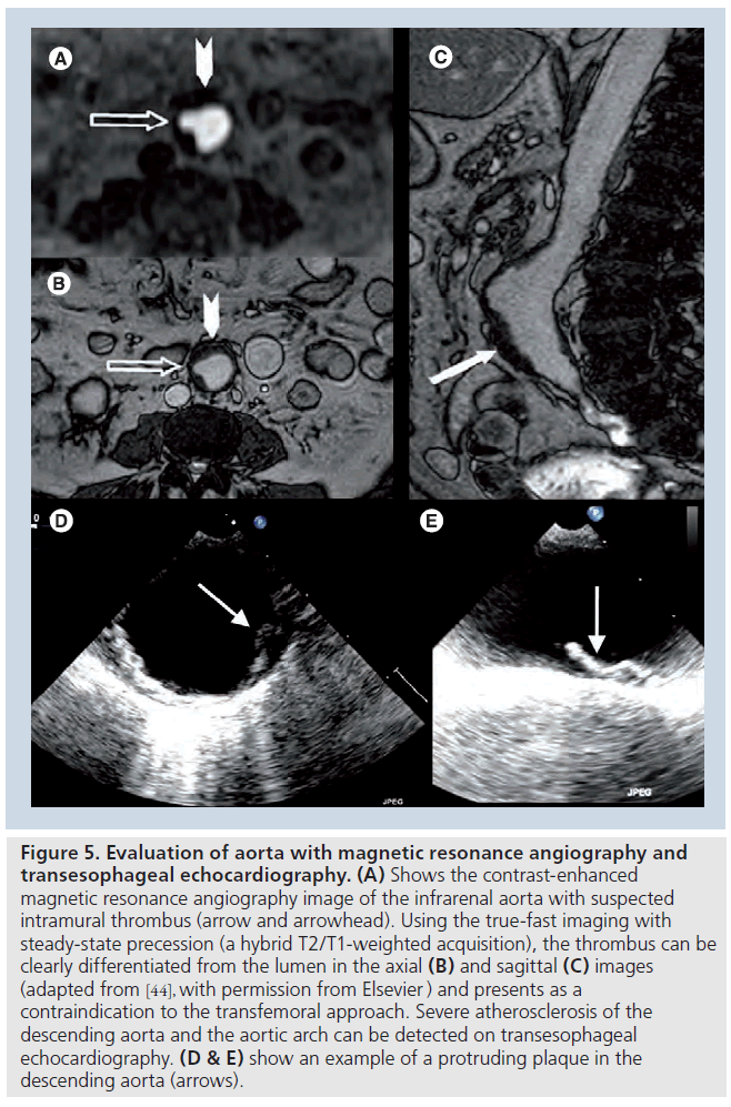 interventional-cardiology-plaque