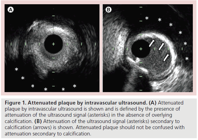 interventional-cardiology-plaque-signal