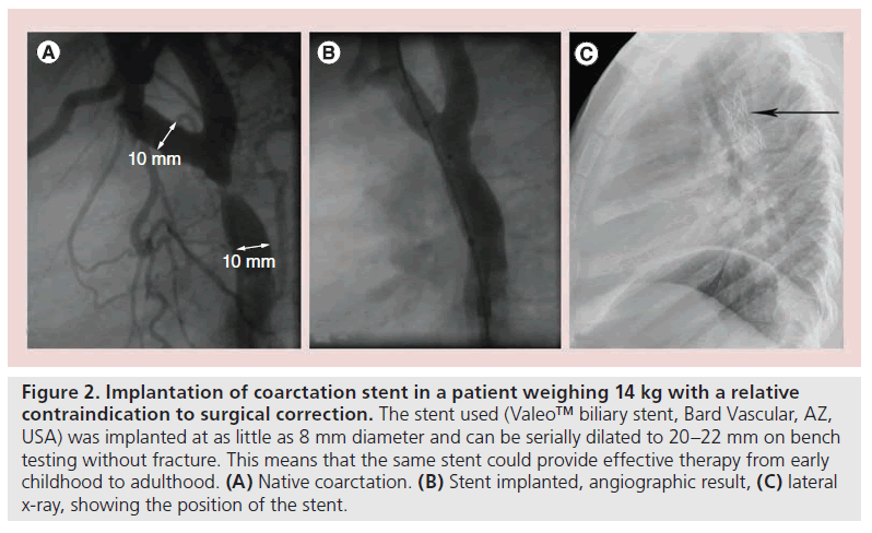 interventional-cardiology-position-stent