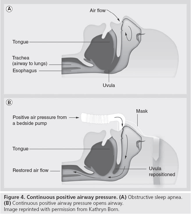 interventional-cardiology-positive-airway-pressure