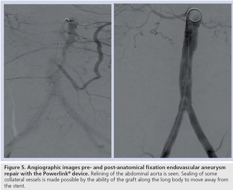 interventional-cardiology-post-anatomical-fixation