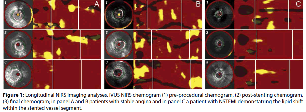 interventional-cardiology-post-stenting