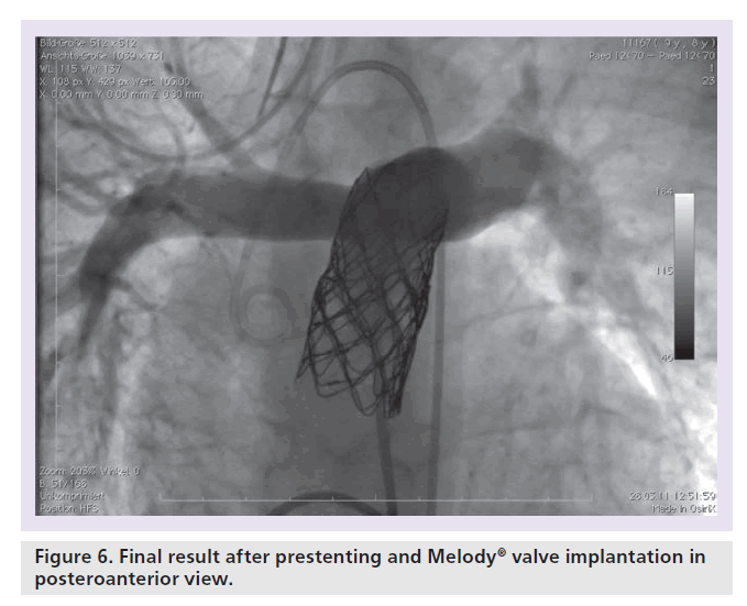 interventional-cardiology-posteroanterior-view