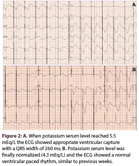 interventional-cardiology-potassium-serum-level